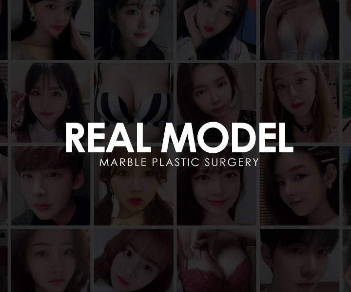 코성형후기 관리의 중요성! 코수술후관리법 마블성형외과의원 관련 이미지 7