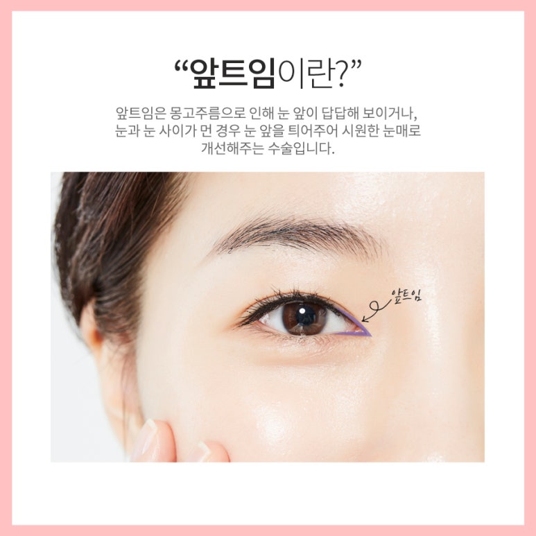 앞트임흉살 걱정되시나요? 마블성형외과의원 관련 이미지 2
