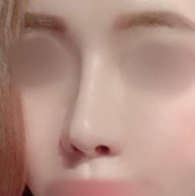 [강남역성형외과 매부리코성형 후기] 첫 수술 실패한 복코 매부리코.. 재수술로 완벽하게 성공했어요! 관련 이미지 7