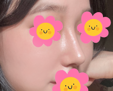 [Marble Plastic Surgery Nose Surgery Review] I Kept Worrying About My Hump Nose... I Should Have Had Surgery Sooner image 8