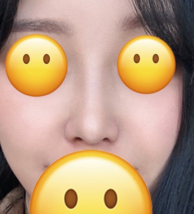 [Bulbous Nose Surgery Review] Solved My Plain Bulbous Nose Concerns! I Got a More Defined Nasal Bridge and a Better Impression! image 8