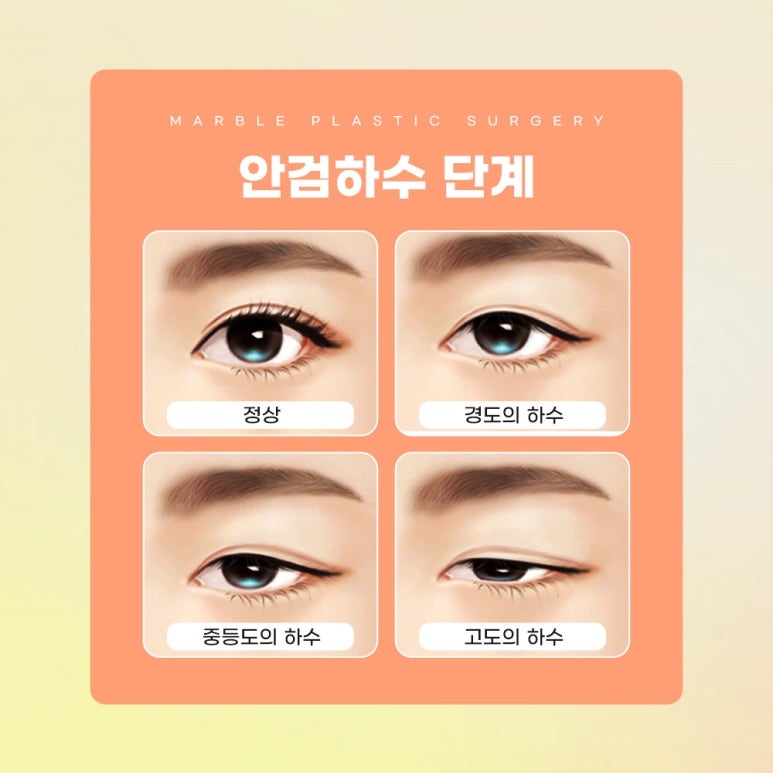 남자눈매교정가격, 잘 알아보고 결정 관련 이미지 8