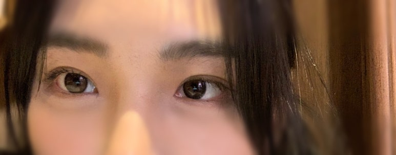 자연유착재수술 하지 않으려면 관련 이미지 1