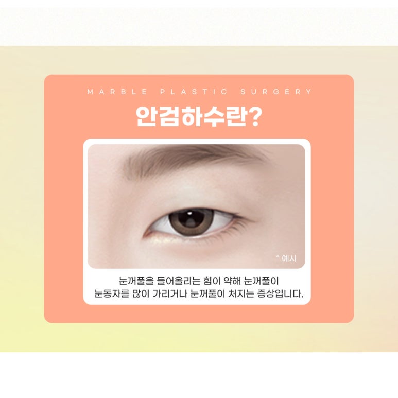 눈매교정비용보다는 결과에 집중하자! 마블성형외과 관련 이미지 3