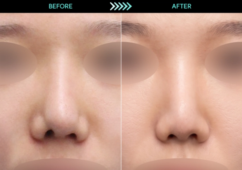 [Revision Rhinoplasty] 2 Months After Bulbous Nose Correction: The Standard Approach to Bulbous Nose and Short Nose Correction image 3