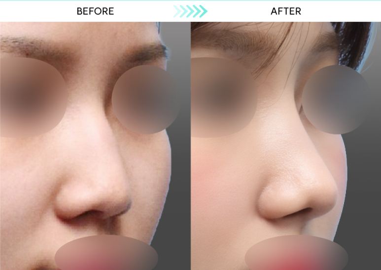 [First Rhinoplasty] Month 2 of Hump Nose Correction: The Standard for Implant-Free Hump Nose Correction image 2