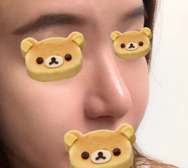 [강남역성형외과 매부리코수술 후기] 코재수술이라 진짜 무서웠는데 매부리코, 복코교정 한번에 해결 됐어요! 관련 이미지 3