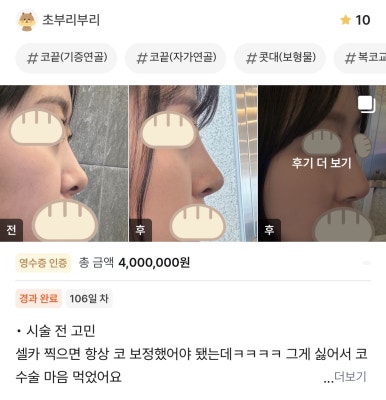 [강남성형외과 복코성형 후기] 보정하기 바빴던 펑퍼짐한 복코.. 얼굴 밸런스에 맞게 바꿔주셨어요! 관련 이미지 1
