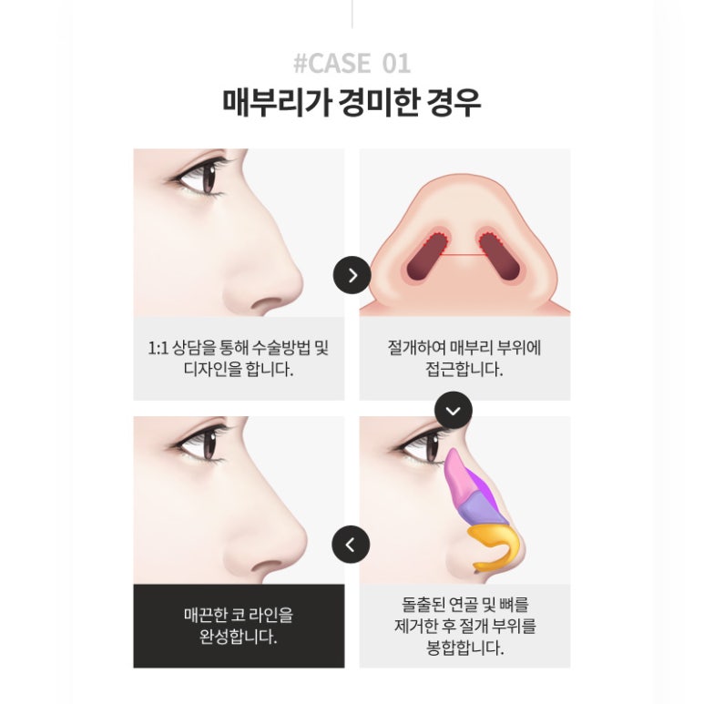 매부리코 성형, 매끄러운 코 라인 마블성형외과의원 관련 이미지 5