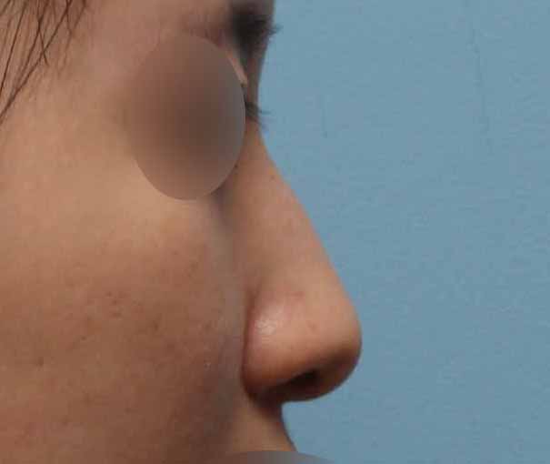 매부리코수술 전후 공개, 과하지 않게 교정한 리얼 경험 관련 이미지 3