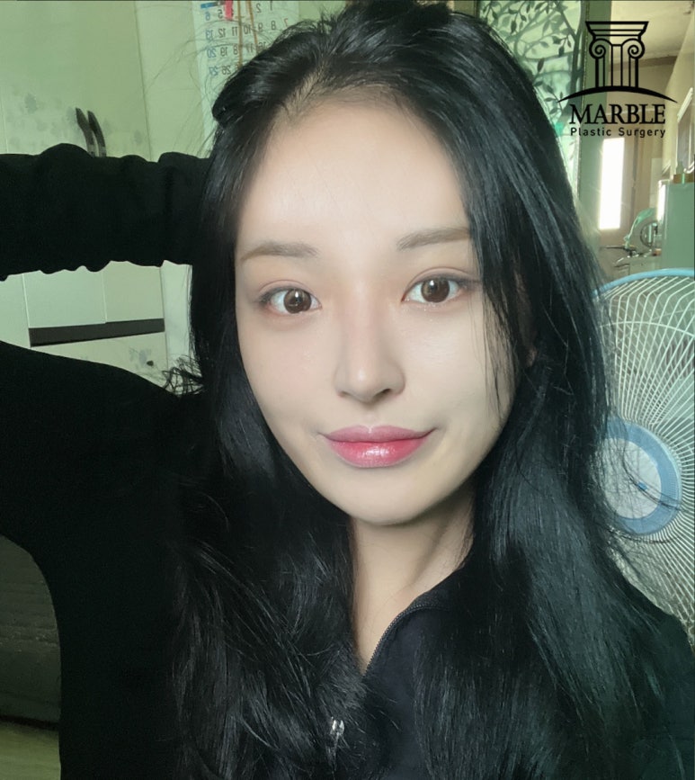 앞트임수술, 답답한 눈 탈출은 마블성형외과의원! 관련 이미지 4