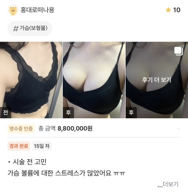 [Gangnam Plastic Surgery Breast Augmentation Review] I was stressed about volume... I found the perfect fit with a ribcage-customized designㅎㅎ image 1