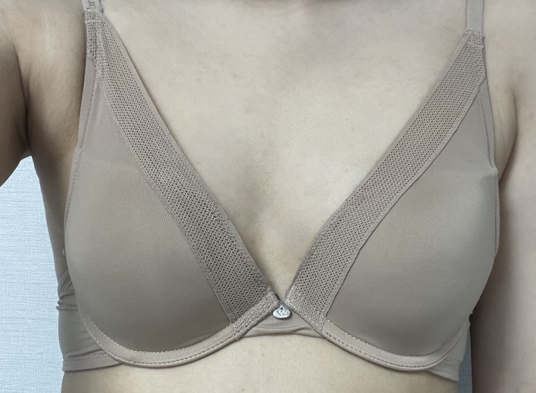 One-Month Real Review After Breast Augmentation ｜ From Right After Surgery to the Changes Over Time image 3