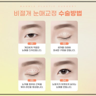 눈매교정 수술, 나도 필요한가? 관련 이미지 6