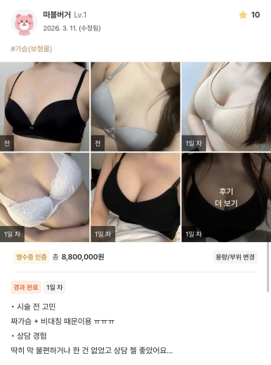 [마블성형외과 가슴성형 후기] 비대칭, 짝짝이 가슴 모양이 스트레스였어요.. 관련 이미지 1