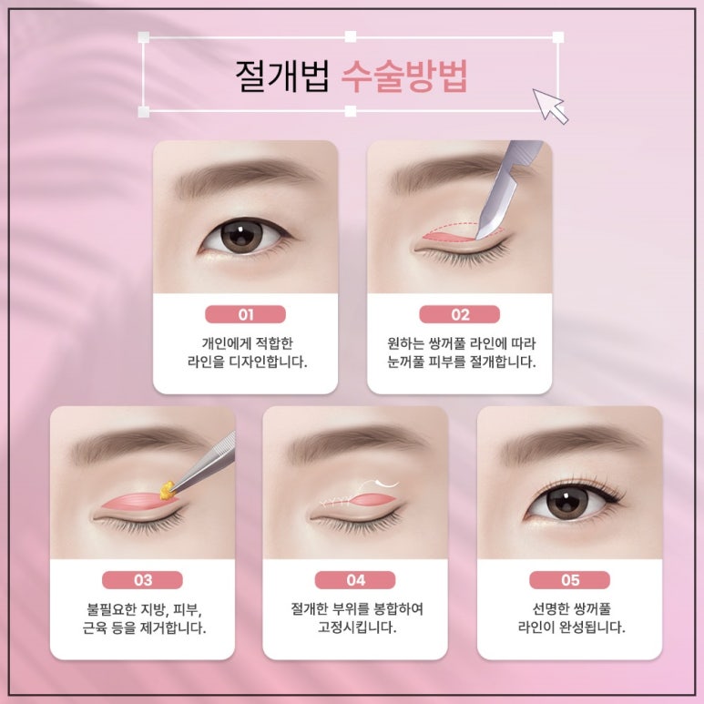 고등학생성형이벤트와 절개법쌍꺼풀잘하는곳 선택하기 관련 이미지 5