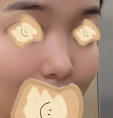 [Gangnam Station Plastic Surgery Nose Revision Review] A Tearful 4th Revision Marked by Failure... I Met Dr. Kim Jun-hyung and Succeeded! image 4