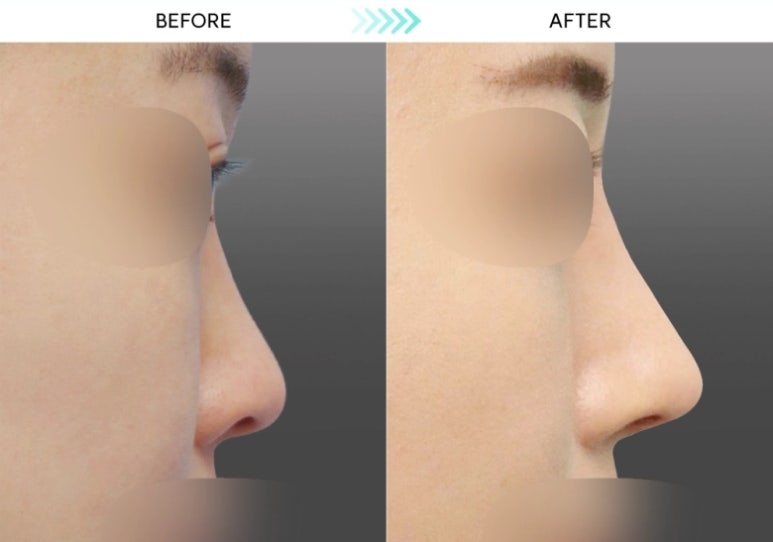[First Rhinoplasty] Three Months After Hump Nose Correction: The Standard Approach to Nasal Tip Osteotomy and Hump Nose Correction image 5