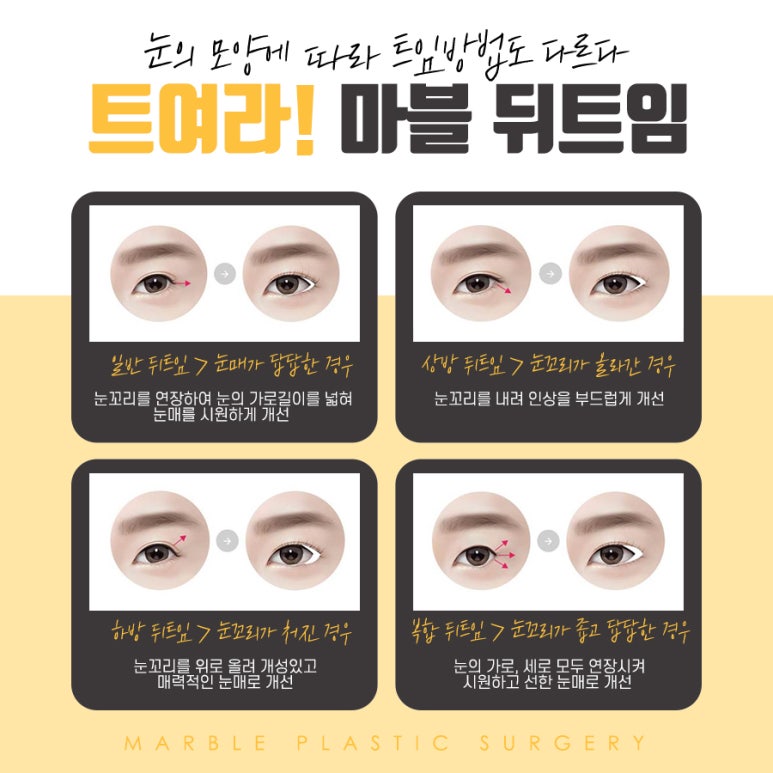 눈뒤트임이 고민이라면? 마블성형외과의원 관련 이미지 3