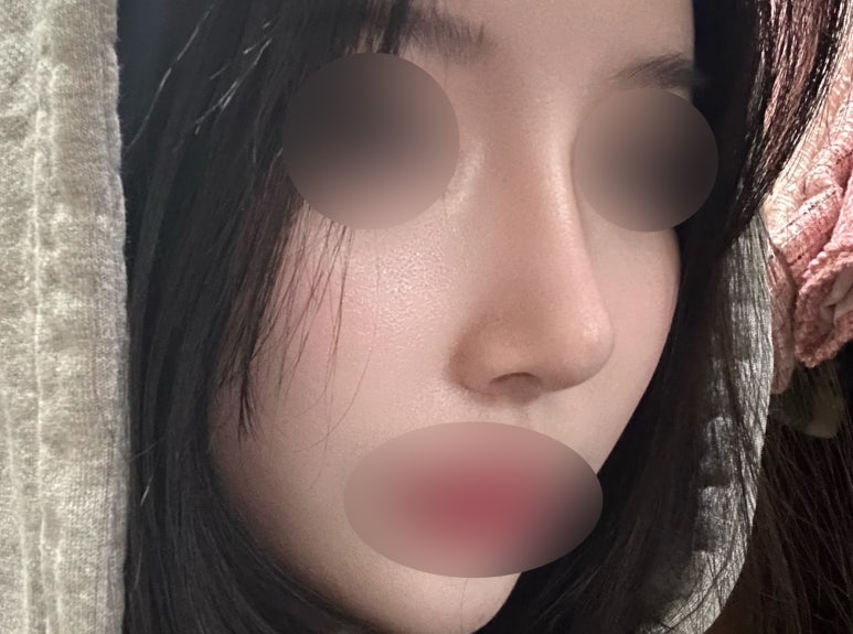 서초구 코수술 잘하는곳 마블성형외과에서 예쁜 코라인으로 변화 관련 이미지 6