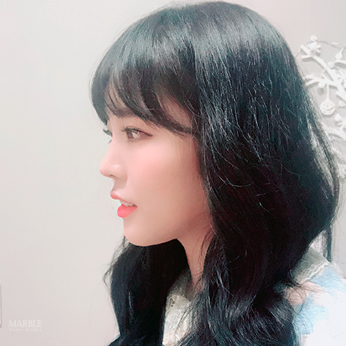 매부리코 성형, 매끄러운 코 라인 마블성형외과의원 관련 이미지 1