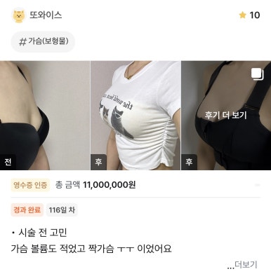 [Gangnam Plastic Surgery Breast Surgery Review] My Uneven Breasts Made Clothes Fit Poorly… Thanks to Director Seo Il-beom, I Finally Resolved the Issue! image 1