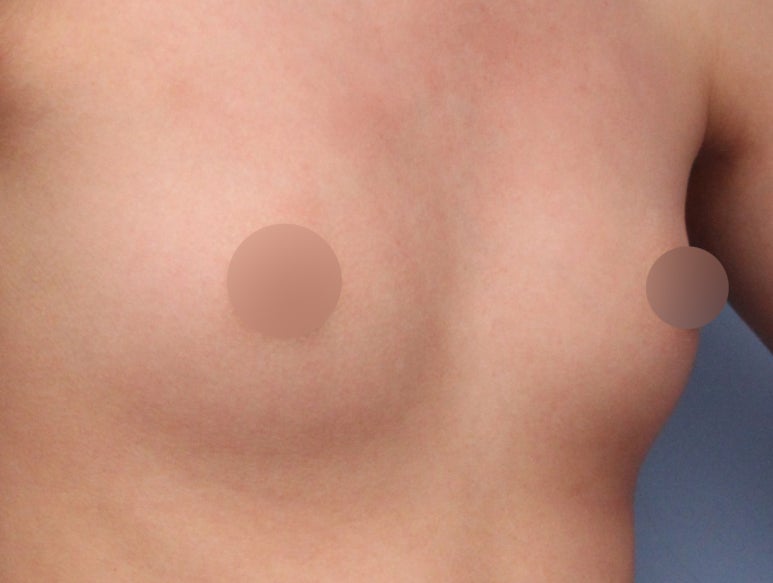 가슴성형 잘하는곳 : 보형물, 가격, 첫 수술 계획까지 관련 이미지 3