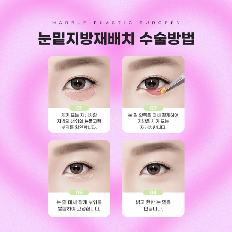 눈밑지방재배치수술후 성공적인 변화 마블성형외과 관련 이미지 4