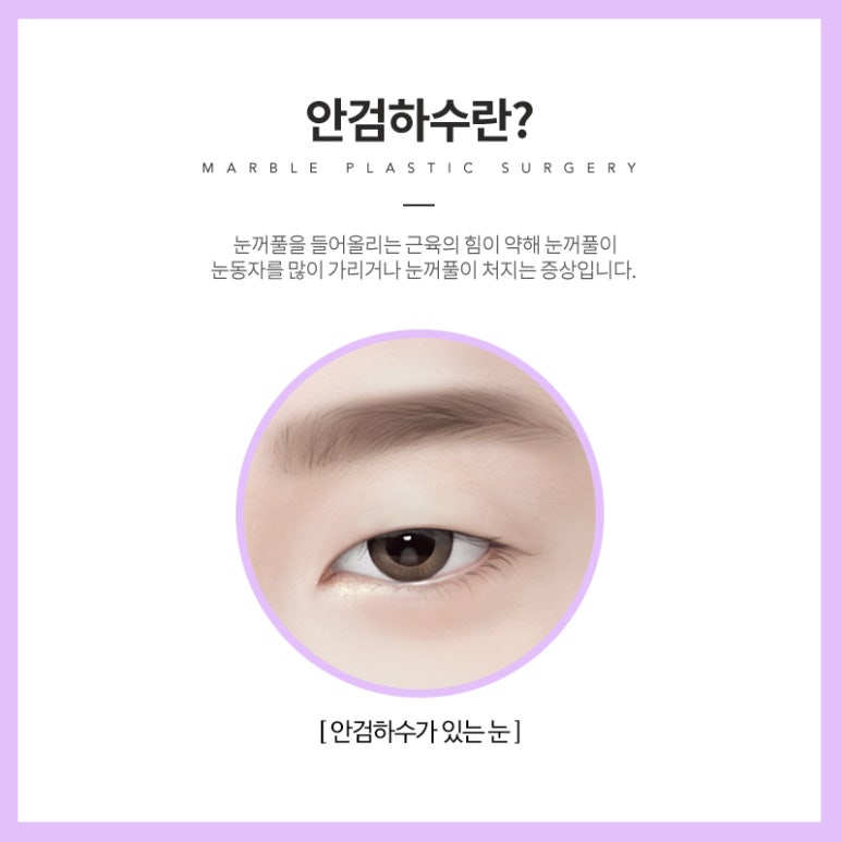 안검하수 처진눈 교정으로 또렷한 눈매를! 관련 이미지 5