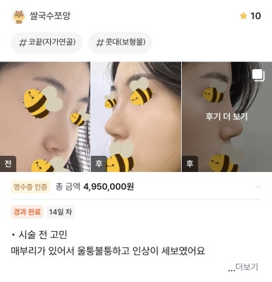 [강남성형외과 매부리코성형 후기] 보기 싫었던 매부리코,, 자려한 인생 코라인 찾아 고민 해결했어요! 관련 이미지 1