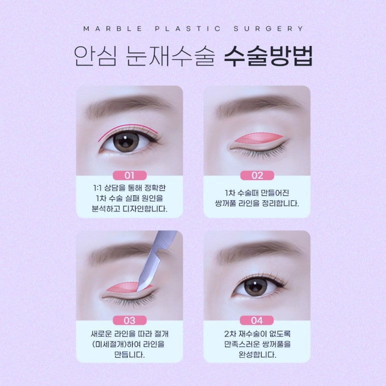 눈재수술 잘 알아봐야 관련 이미지 7