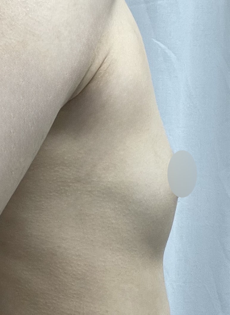 One-Month Real Review After Breast Augmentation ｜ From Right After Surgery to the Changes Over Time image 2