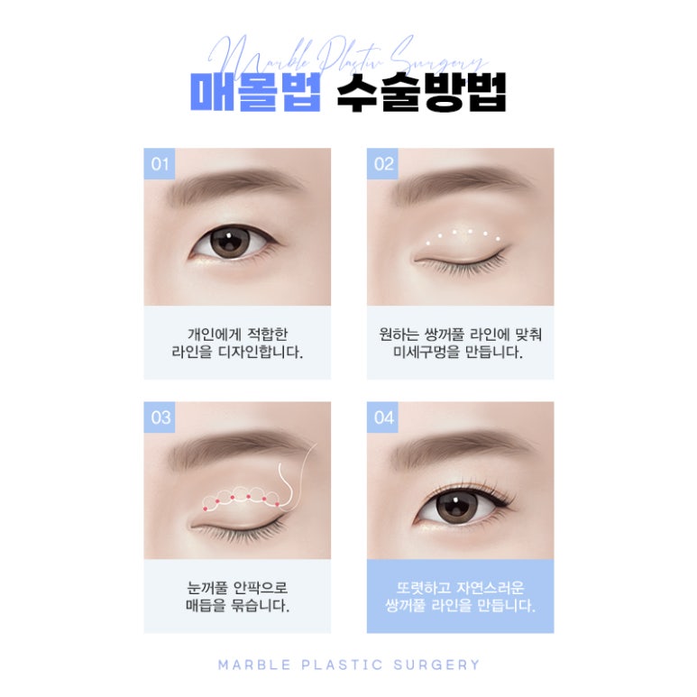 눈성형 매몰법으로 자연스럽고 조화로운 눈매 관련 이미지 5