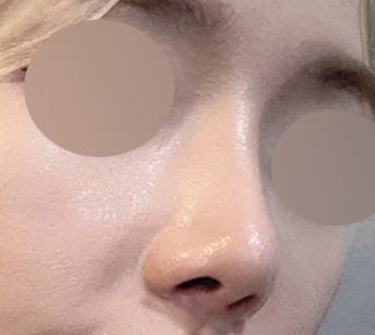 [Gangnam Plastic Surgery Clinic Hump Nose Surgery Review] Worried It Might Look Unnatural, I Hesitated About My Hump Nose… Adding Bulbous Nose Correction Helped Me Settle on My Perfect Nose Line! image 8