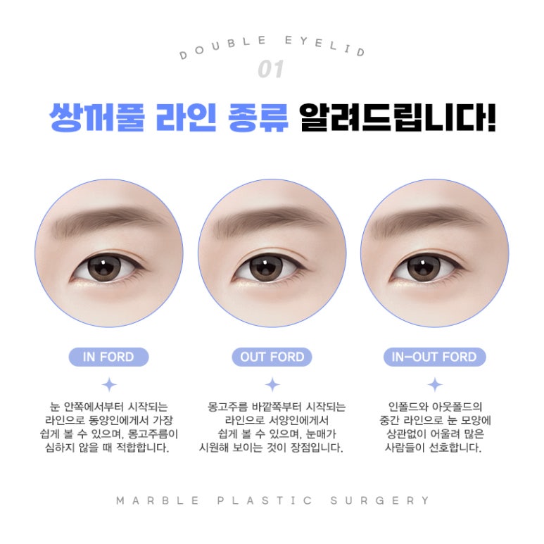 첫눈성형 성공 확률 높이기 위해서 관련 이미지 4