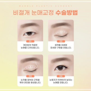 눈성형수술잘하는곳, 마블성형외과의원 관련 이미지 6