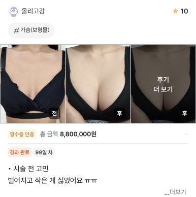 [Gangnam Station Plastic Surgery Clinic Breast Surgery Review] I hated having small breasts with no cleavage... Now I feel happy every time I look in the mirror! image 1