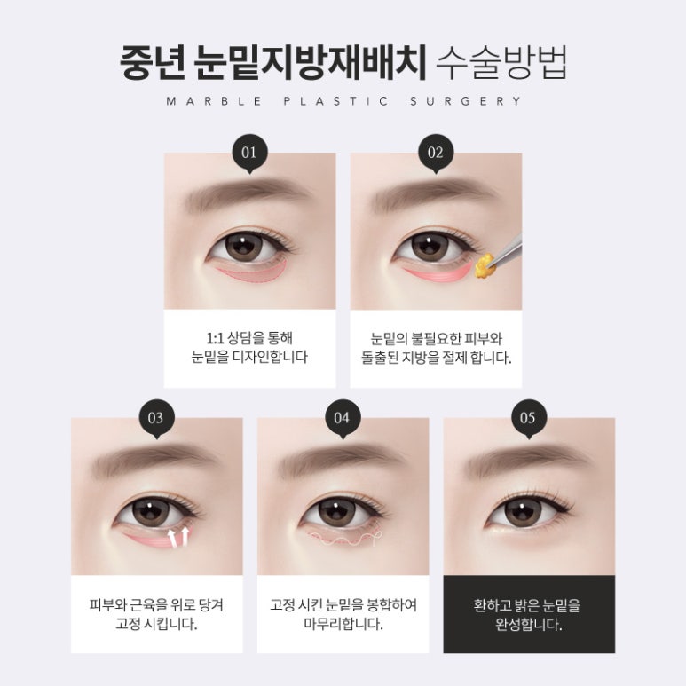 중년눈성형 작은 변화가 만든 아름다운 동안 눈매 관련 이미지 5