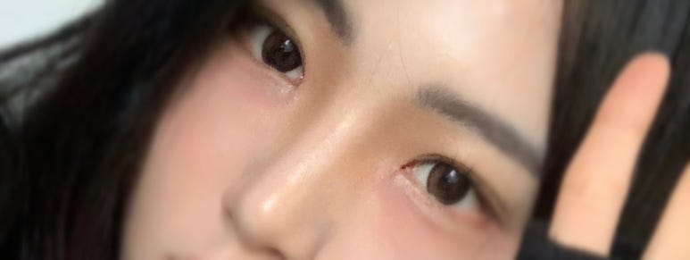 자연유착재수술 하지 않으려면 관련 이미지 2