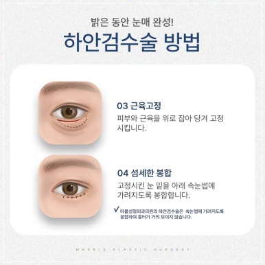 Differences in Lower Eyelid Surgery by Age Group and Recommended Methods: Showing Your Parents Appreciation Through Lower Eyelid Surgery (Before-and-After Photos O) @ Marble Plastic Surgery Clinic image 8