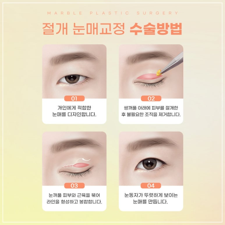 눈매교정 수술, 꼭 필요한가? 관련 이미지 5
