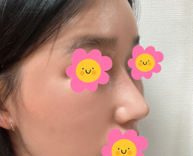 [Marble Plastic Surgery Nose Surgery Review] I Kept Worrying About My Hump Nose... I Should Have Had Surgery Sooner image 7