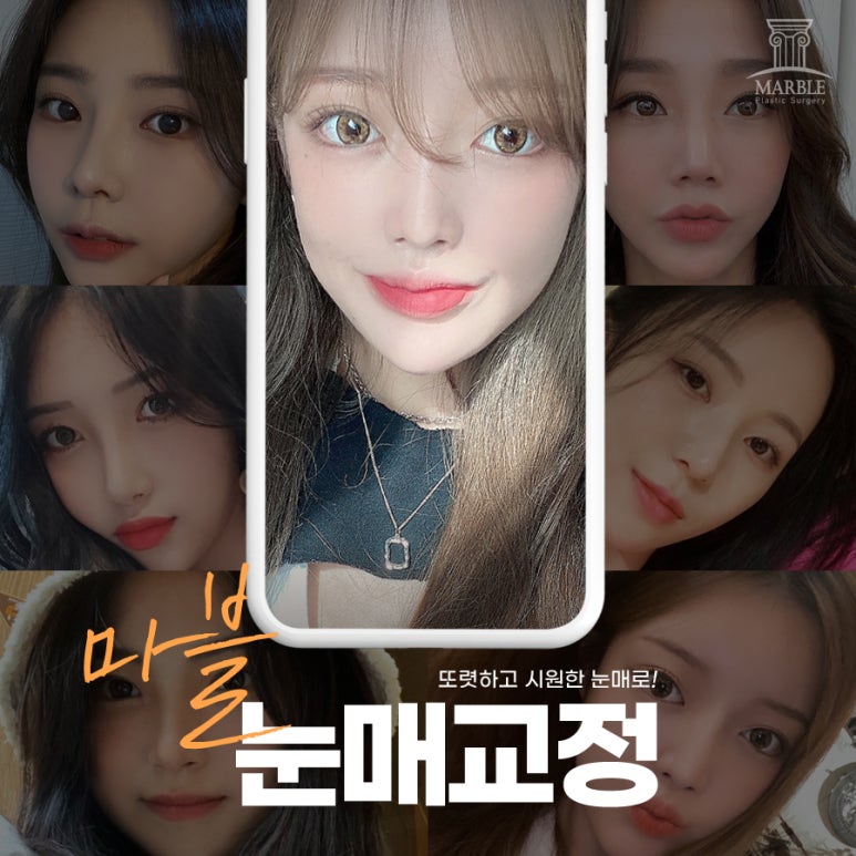 눈매교정 부작용 증상 어떤 것들이? 관련 이미지 2