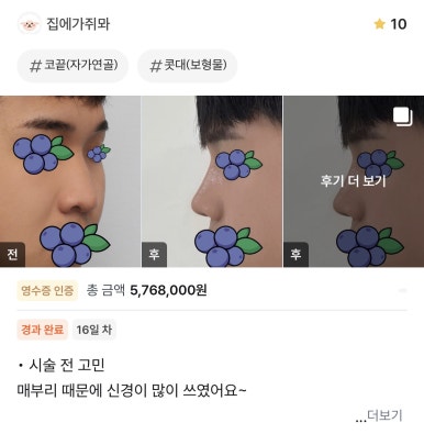 [강남성형외과 매부리코수술 후기] 울퉁불퉁한 옆 라인 고민.. 자가늑 덕분에 또렷한 콧대로 변신했어요! 관련 이미지 1