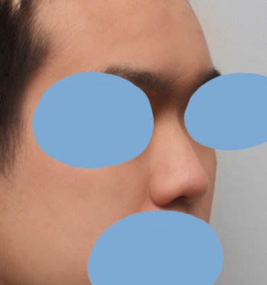 [Gangnam Plastic Surgery Male Nose Surgery Review] After tidying up the hump and bulbous nose that made me look stuffy, my T-zone and facial features looked completely alive! image 3