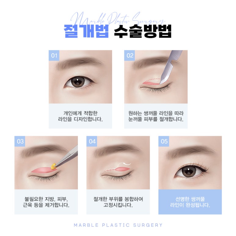 절개쌍꺼풀수술 또렷한 라인으로 눈매를 시원하게! 관련 이미지 5