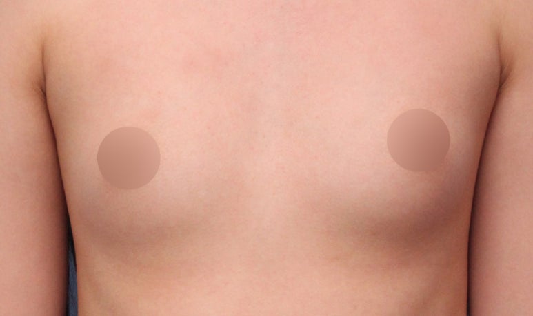 가슴성형 잘하는곳 : 보형물, 가격, 첫 수술 계획까지 관련 이미지 2