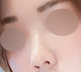 [강남성형외과 매부리코성형 후기] 필러 변형에 점점 이상해지는 콧대.. 필러제거 후 인생 코 정착 완료! 관련 이미지 5