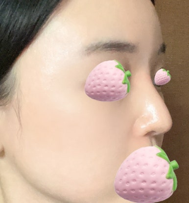 [강남성형외과 코재수술 후기] 무너졌던 코 기둥..ㅠㅠ 반년 발품 고생 끝에 인생 옆라인 찾았어요! 관련 이미지 3