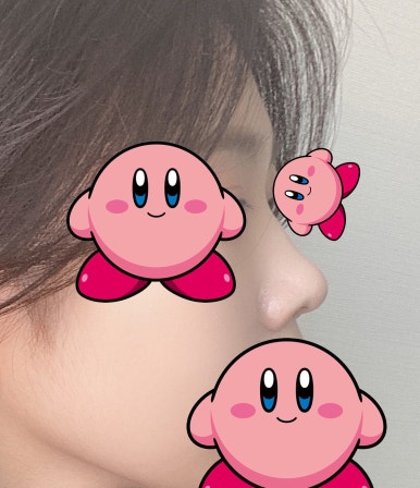 [강남역성형외과 복코수술 후기] 빡센 다이어트도 소용없던 복코.. 아이돌 코로 다시 태어났어요! 관련 이미지 5